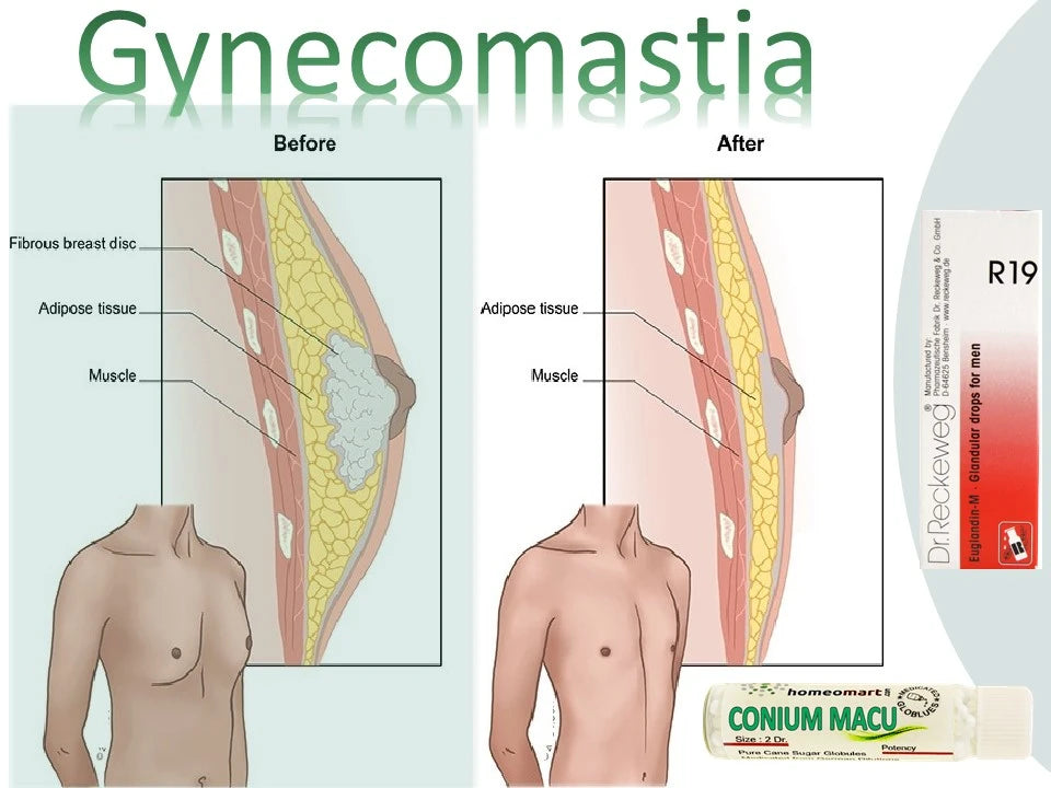  Gynecomastia Treatment with natural safe remedies for 100% results