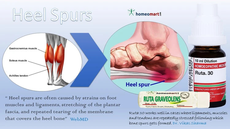 Homeopathy treatment for heel spurs with Ruta Graviolens and Homeomart branding.