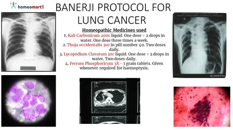 Banerji Protocol offers a systematic homeopathic approach to lung cancer symptoms like haemoptysis and breathlessness, using key remedies such as Kali Carbonicum 200c and Thuja Occidentalis 30c for holistic respiratory and tumor support