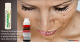 Psorinum product with a close-up of a woman's face showing oily skin issues.