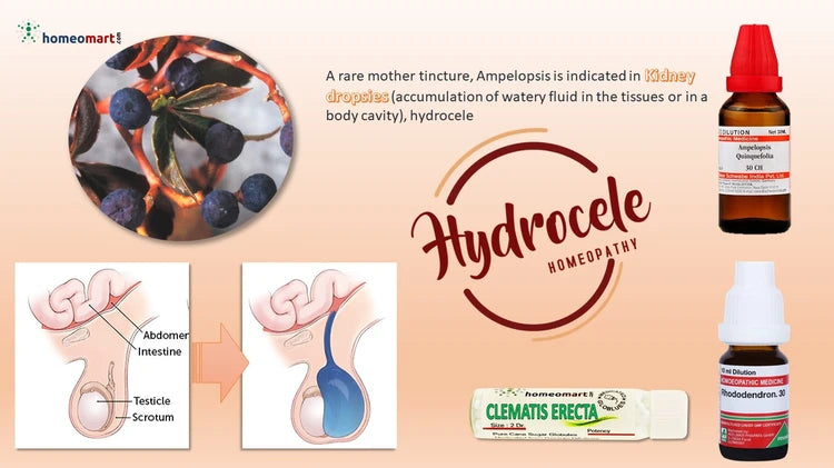 natural remedies in homeopathy for Hydrocele treatment without surgery