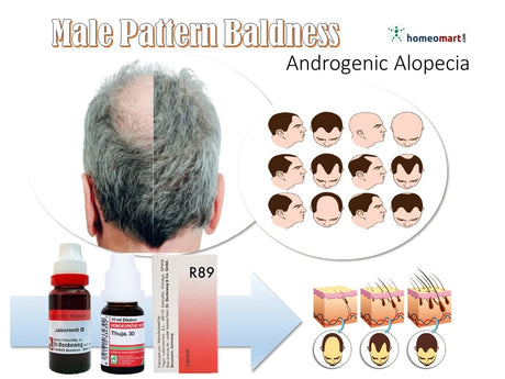 Illustration of male pattern baldness progression with homeopathy remedies to indicate 'How to reverse male pattern baldness naturally'
