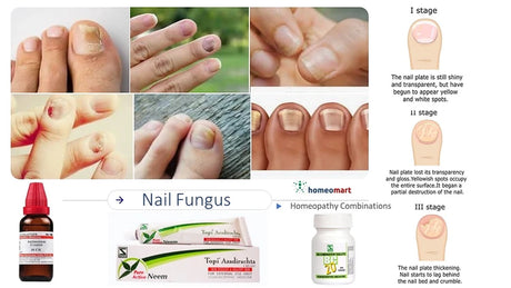 Collage of nail conditions and homeopathic remedies for nail fungus, with text on stages of nail fungus.