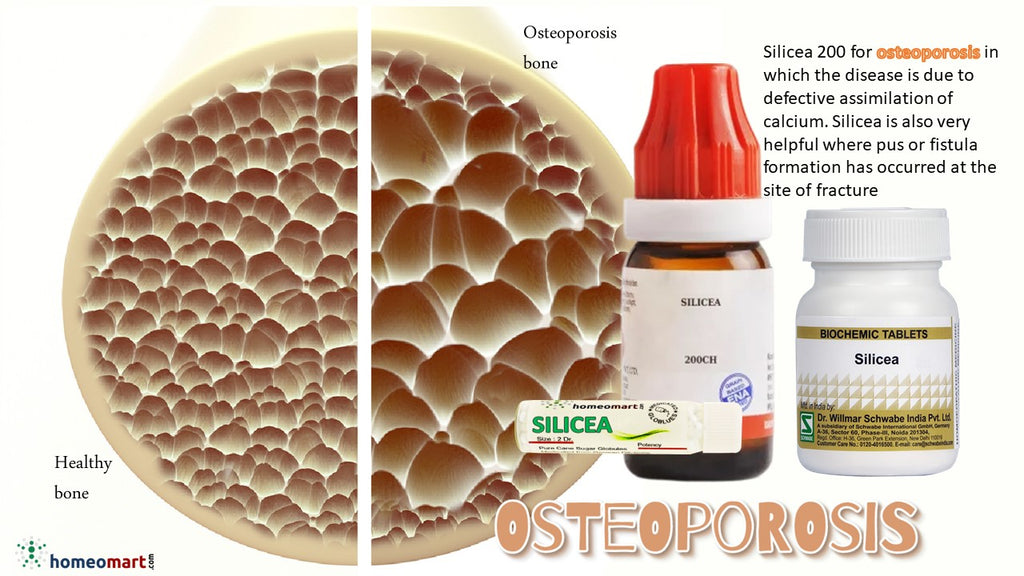 Role of calcium in osteoporosis homeopathy silicea for better assimilation