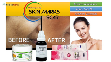 For those who wish to try treating scars at home, these homeopathy combination provide expert recommended relief
