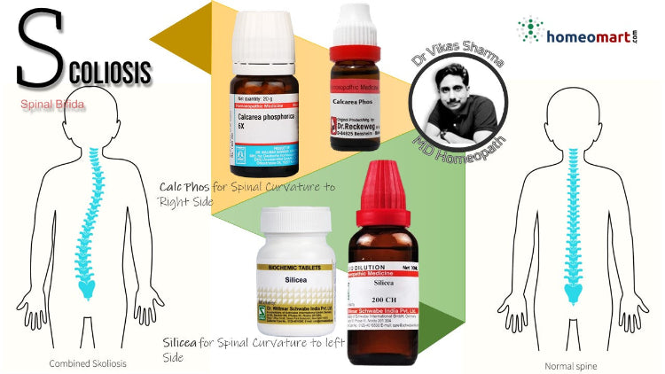 Top Homeopathy Medicines for Scoliosis reatment