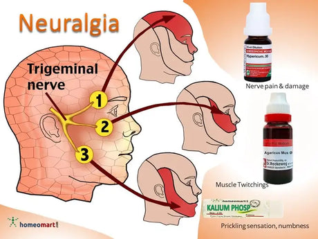 Diagram of trigeminal nerve with neuralgia symptoms and homeopathic medicine bottles.