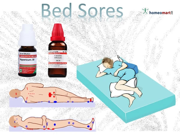 Relieve pain, fight infection, and speed up recovery from bed sores with this trusted homeopathic medicines