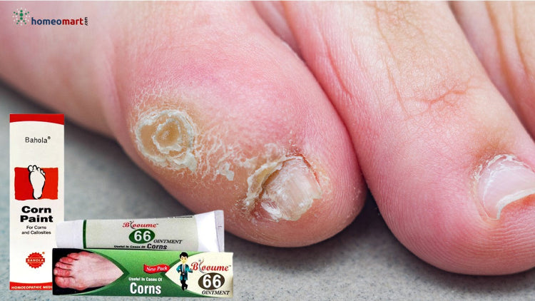 corn on foot treatment at home