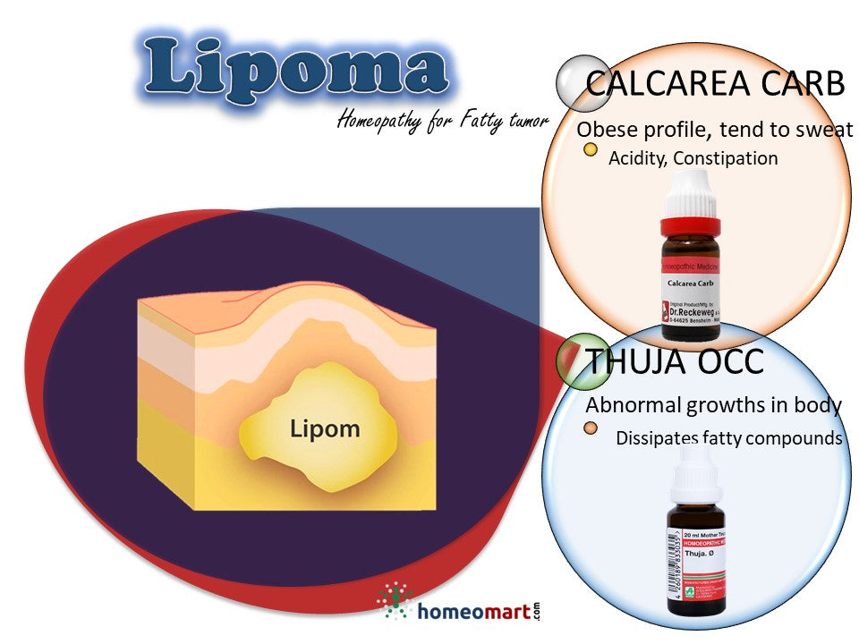 natural remedies to shrink lipoma naturally without side effects