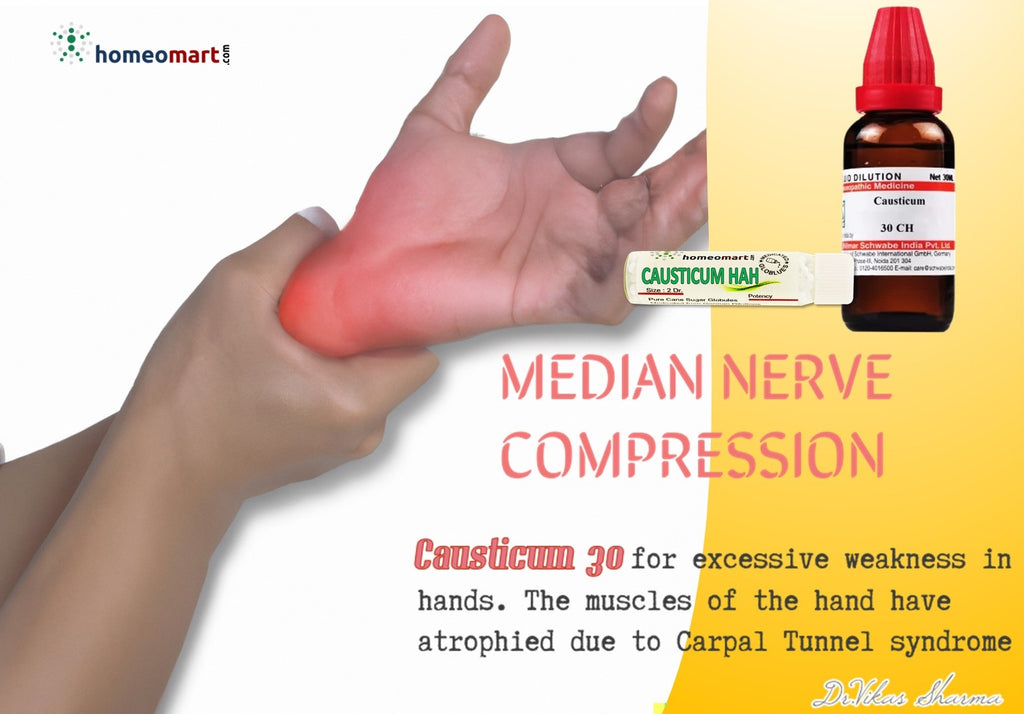 arnica 30 for carpal tunnel syndrome due to typing or repetitive injury 