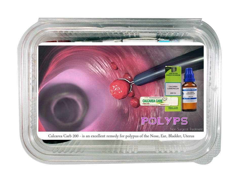 Polyp removal homeopathy medicines 