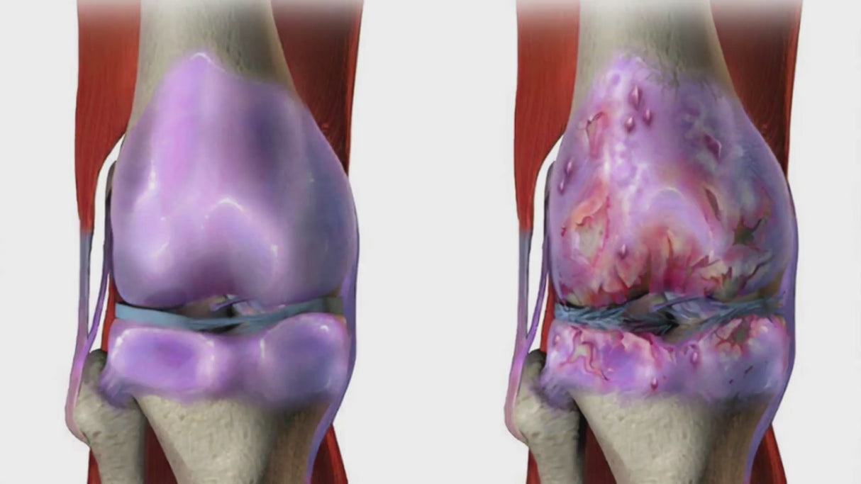 a 17 second video showing a healthy knee and osteoarthritis affected knee with homeopathy medicines for relief