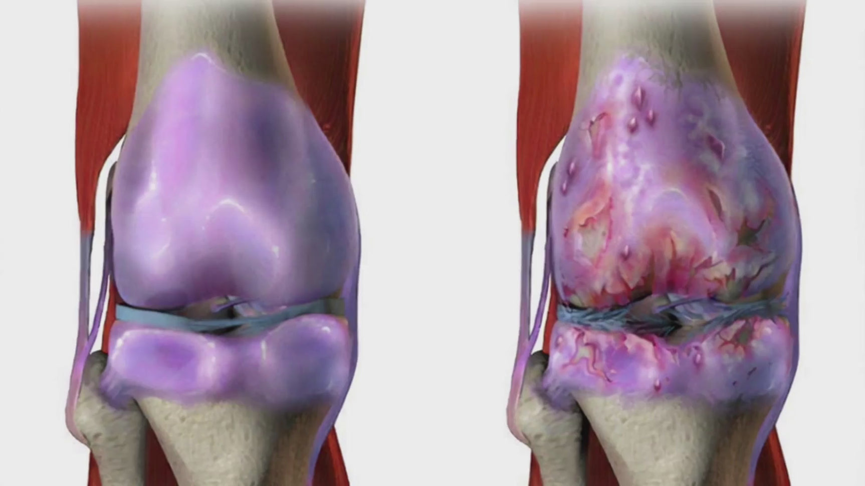 a 17 second video showing a healthy knee and osteoarthritis affected knee with homeopathy medicines for relief