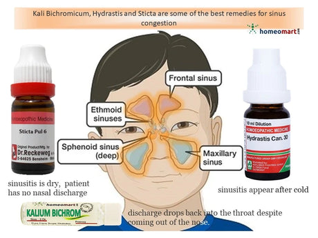 Diagram of sinus anatomy with homeopathic remedies labeled for sinusitis relief
