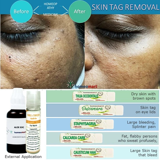 safe natural remedies to remove skin tags on eye lids 
