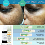 safe natural remedies to remove skin tags on eye lids 
