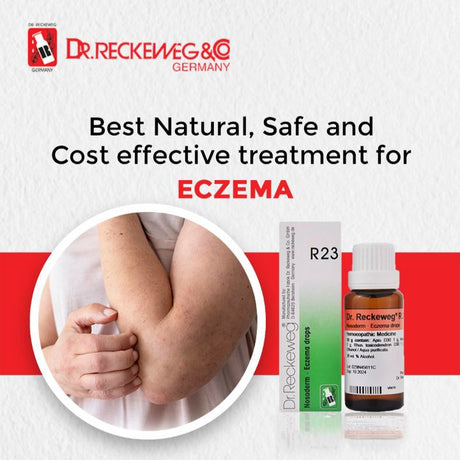 eczema treatment over the counter medicine