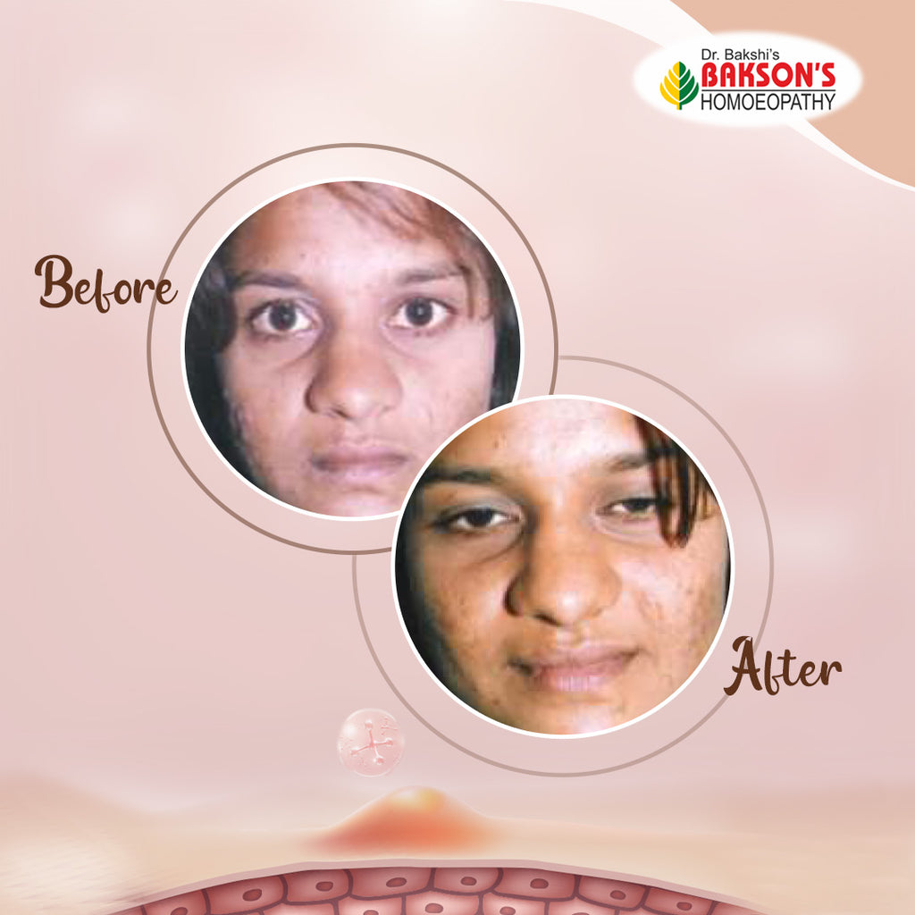 acne treatment with Bakson acne aid before and after picture