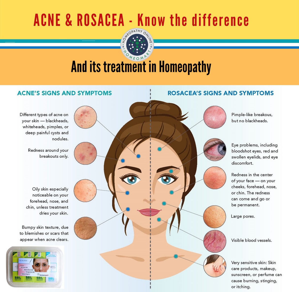 acne and rosacea difference 