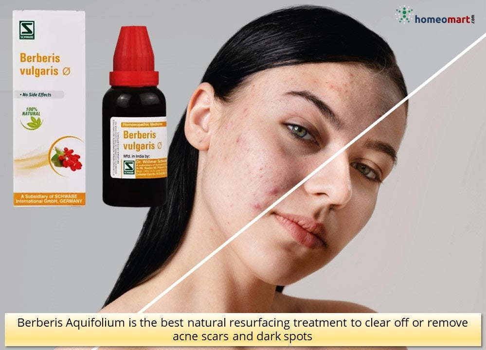 acne scar treatment at home with berberis aquifolium