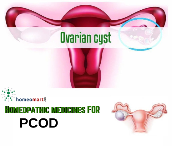 How to cure PCOS permanently with doctor recommended homeopathy solutions