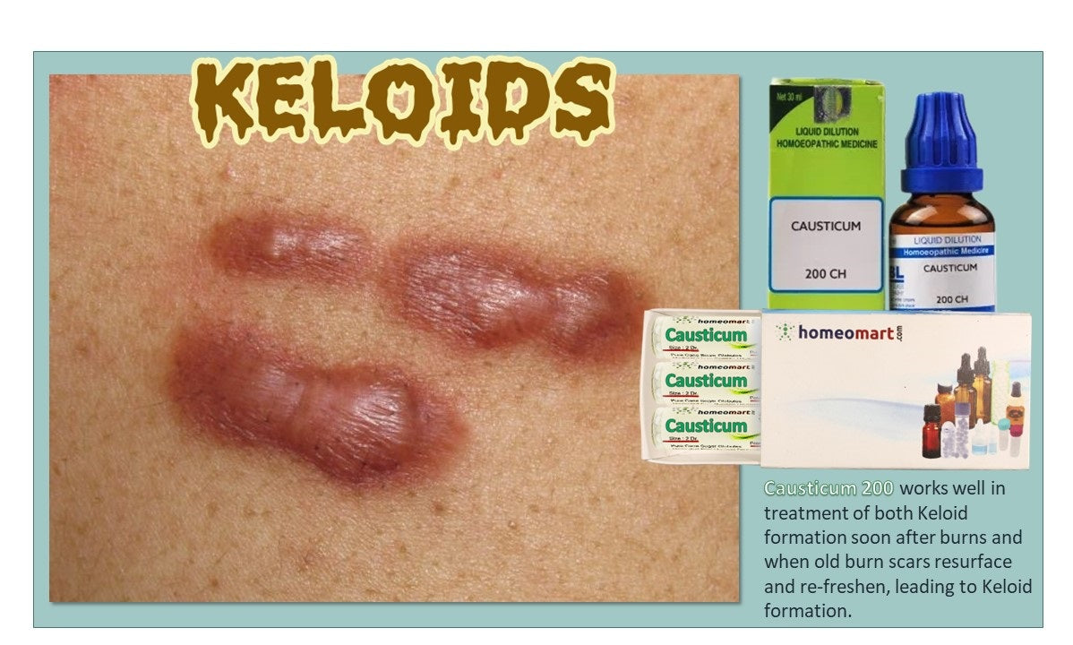 keloid burn scar treatment with causticum homeopathy