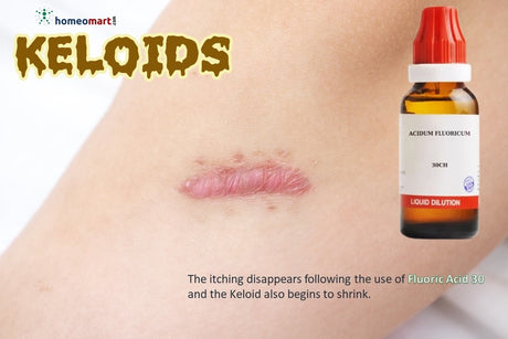 keloid itching remedy acid fluor homeopathy