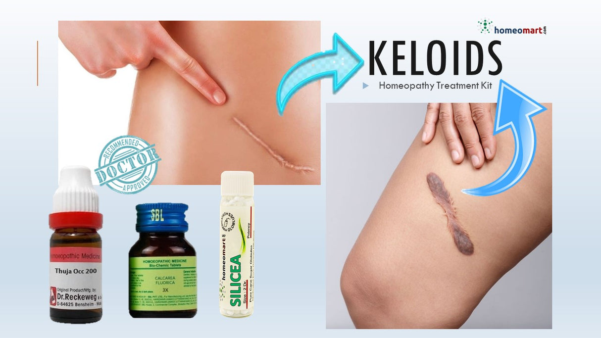 keloid removal at home, non surgical scar treatment, keloid homeopathy kit, scar tissue healing, holistic skin repair, homeopathy for scars
