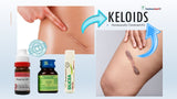 keloid removal at home, non surgical scar treatment, keloid homeopathy kit, scar tissue healing, holistic skin repair, homeopathy for scars