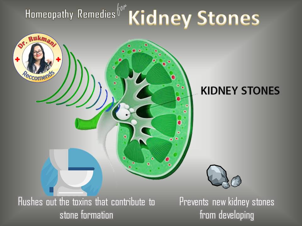 How to pass kidney stones fast