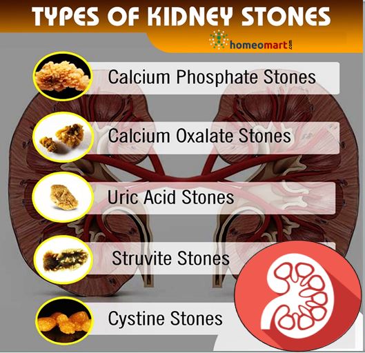 how to dissolve kidney stones fast