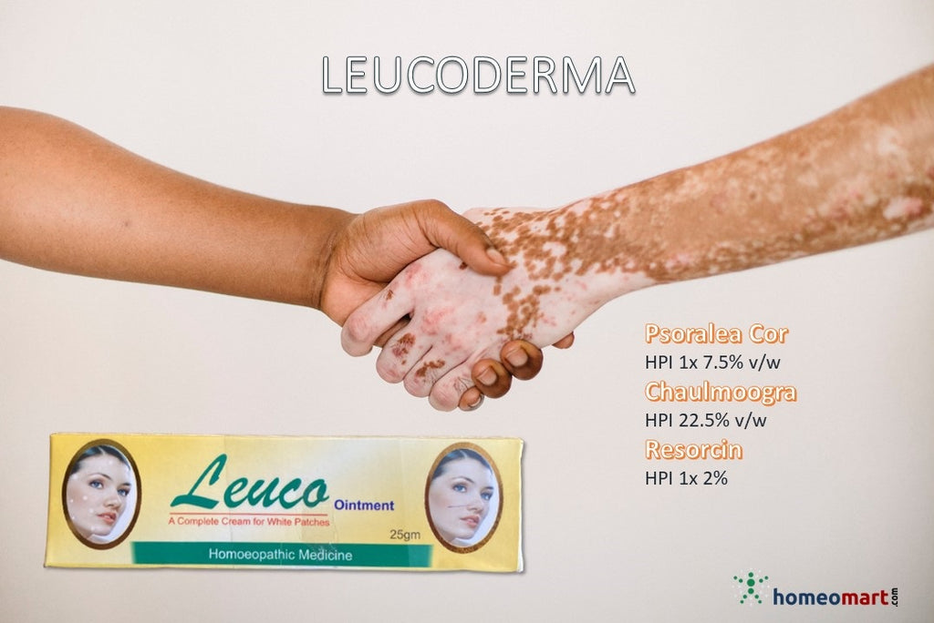 leucoderma cream benefits homeopathy