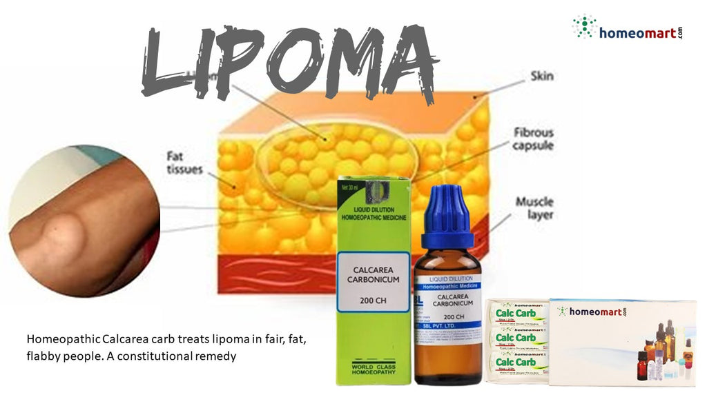 Lipoma dissolve by Homeopathy Calcarea Carbonica 