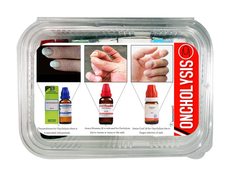 onycholysis treatment medicines homeopathic