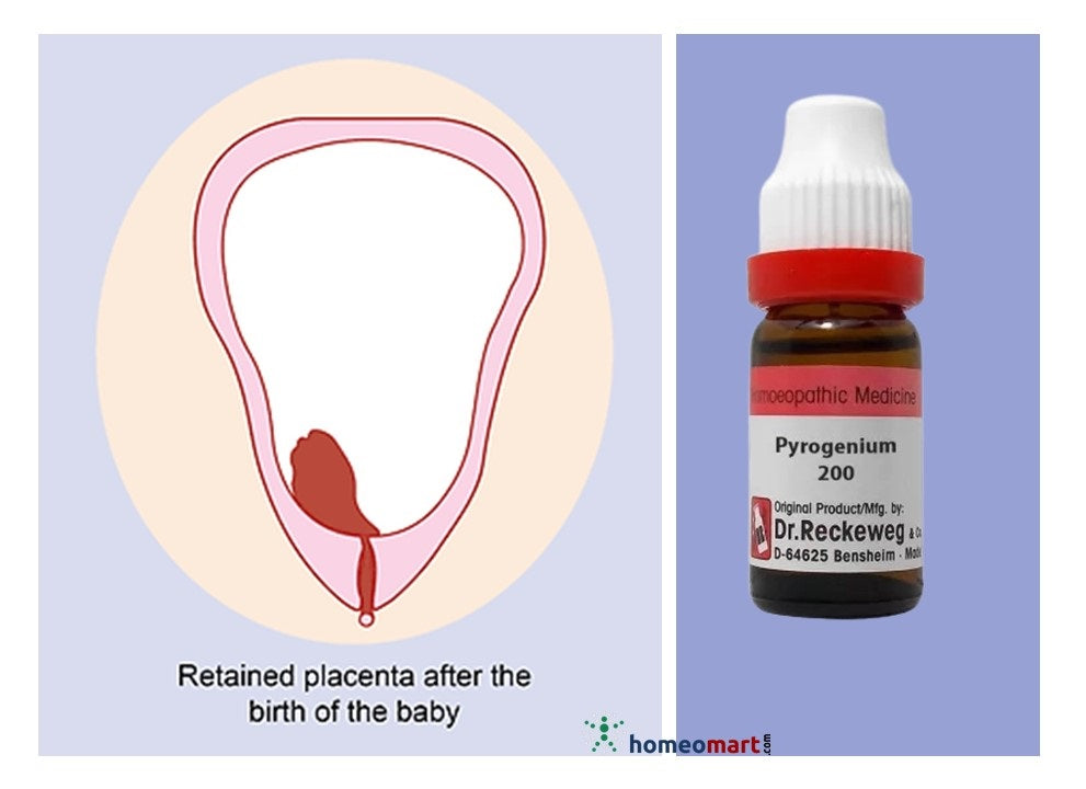 retained placenta treatment homeopathy medicine pyrogenium