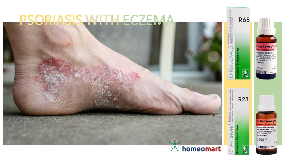 homeopathy treatment for psoriasis with eczema