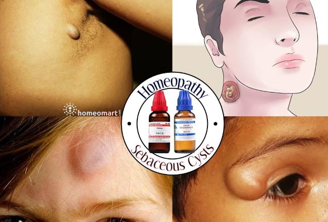 best homeopathy medicine for sebaceous cyst treatment