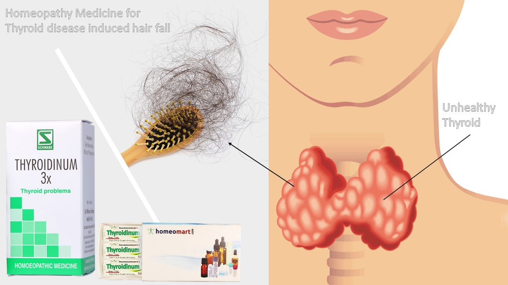 thyroid disease hair fall homeopathy medicine