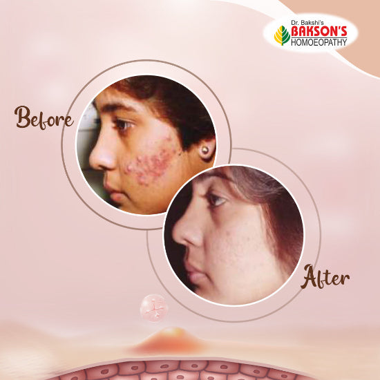 homeopathic acne treatment before after picture