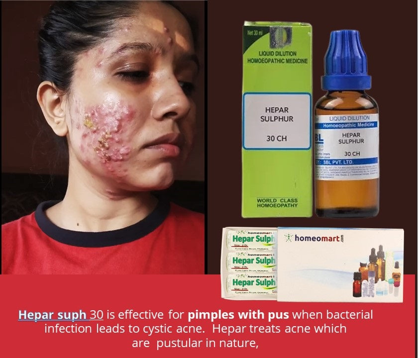 pimples with pus treatment homeopathic hepar Sulph