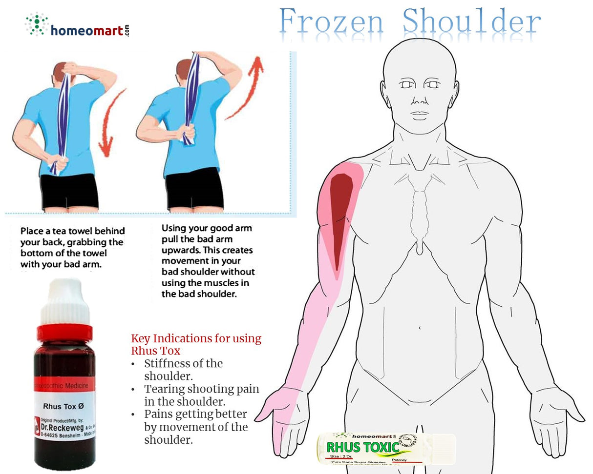 simple frozen shoulder exercise, rozen shoulder recovery homeopathy, shoulder stiffness relief medicine, periarthritis shoulder homeopathy, shoulder pain natural cure, joint stiffness homeopathy, rhus tox for frozen shoulder, ruta for shoulder pain, ferrum metallicum shoulder pain, spondin drops shoulder pain, pain oil for frozen shoulder
