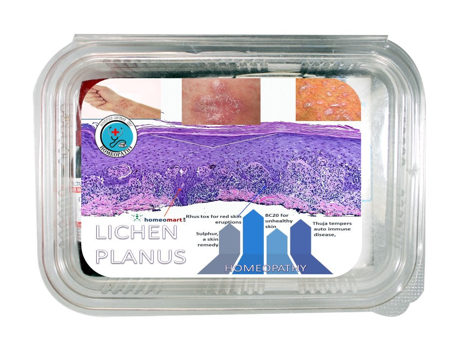 Lichen Planus natural treatment in homeopathy Sulphur Borax BC20