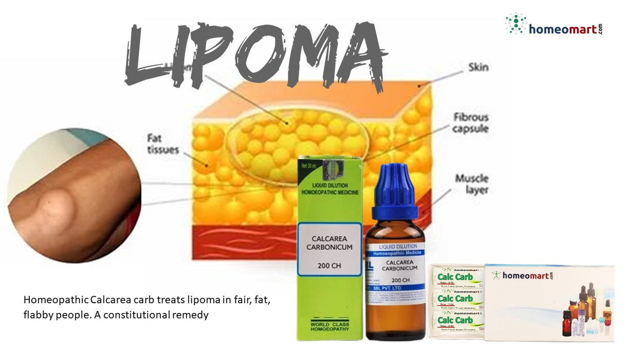 dissolve Lipoma non invasively with Homeopathy Calcarea Carbonica 