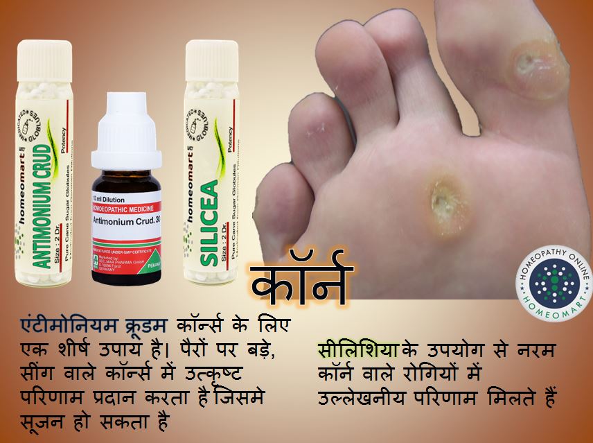 foot crns treatment hindi