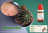 How to get rid of heat rash quickly